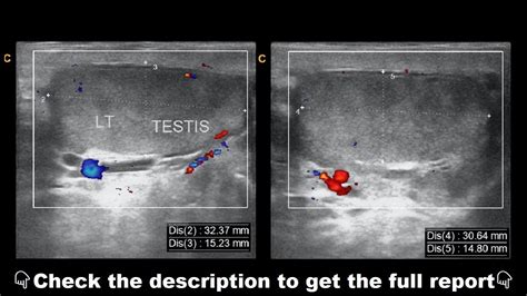 test for testicular torsion ultrasound|incomplete testicular torsion ultrasound.